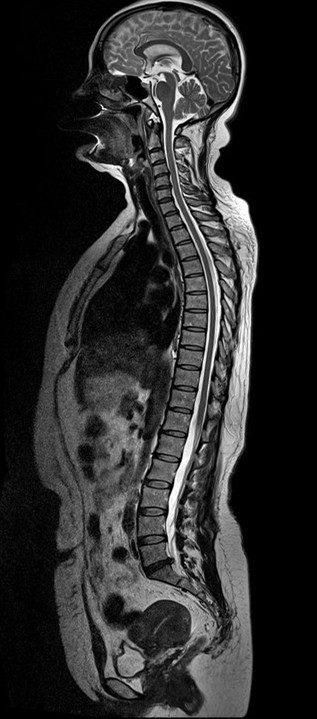 MRI 全脊柱成像.jpg